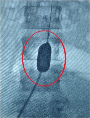 Grade Prediction of Bleeding Volume in Cesarean Section of Patients With Pernicious Placenta Previa Based on Deep Learning